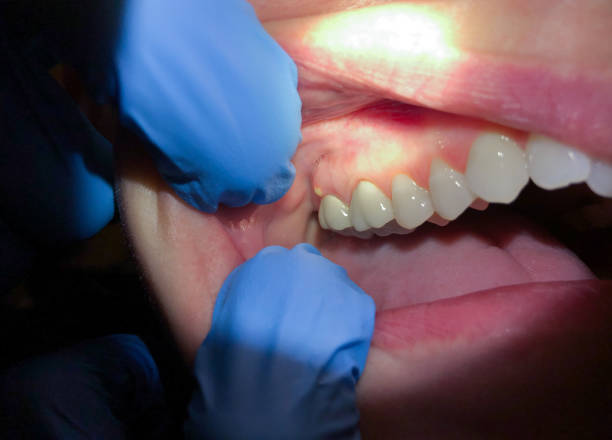 Best Emergency Gum Pain Relief  in Simonton Lake, IN